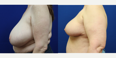 Breast Reduction before and after photo