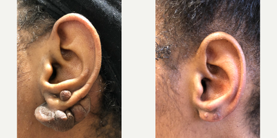 Earlobe Repair before and after photo