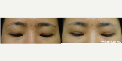 Eyelid Surgery before and after photo