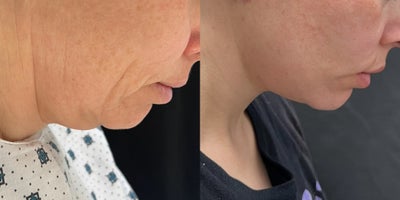 Facelift before and after photo