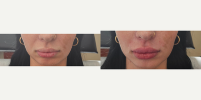 Lip Fillers before and after photo
