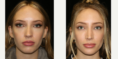 Rhinoplasty before and after photo