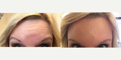 Botox before and after photo