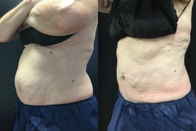 CoolSculpting before and after photo