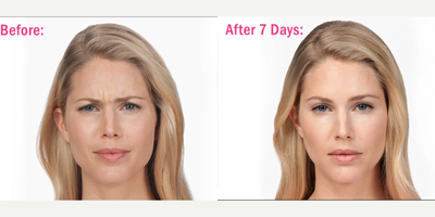 Botox before and after photo