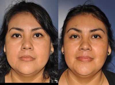 Buccal Fat Removal before and after photo