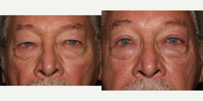 Eyelid Surgery before and after photo