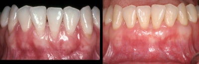 Gum Lift before and after photo