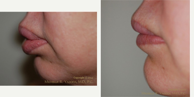 Lip Reduction before and after photo