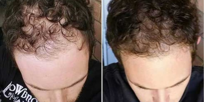PRP for Hair Loss before and after photo