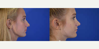 Rhinoplasty before and after photo