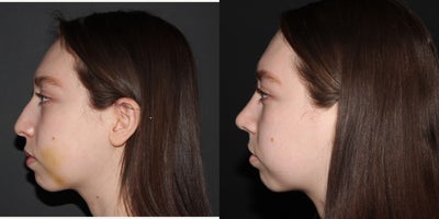 Rhinoplasty before and after photo
