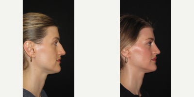 Rhinoplasty before and after photo