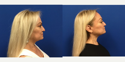 ThermiTight before and after photo