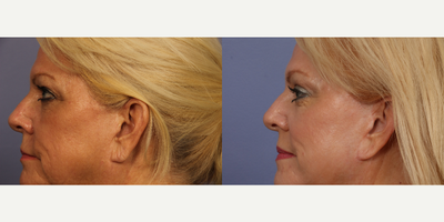 Eyelid Surgery before and after photo