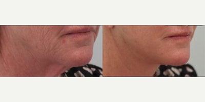 Facelift before and after photo