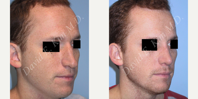 Rhinoplasty before and after photo