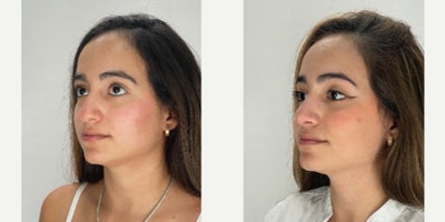 Rhinoplasty before and after photo