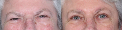 Eyelid Surgery before and after photo