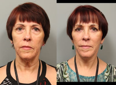 Facelift before and after photo
