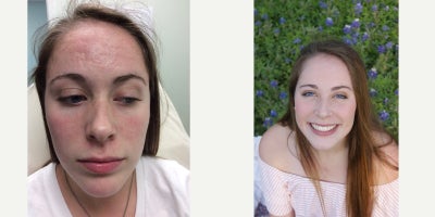 Microneedling before and after photo
