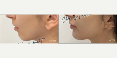 Chin Filler before and after photo