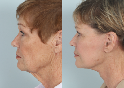 Facelift before and after photo
