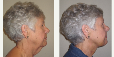 before and after image