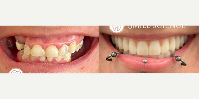 All-on-4 Dental Implants before and after photo