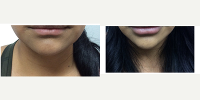 Chin Filler before and after photo