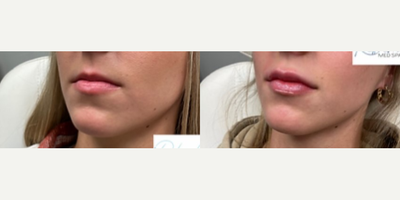 Dermal Fillers before and after photo