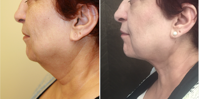FaceTite before and after photo