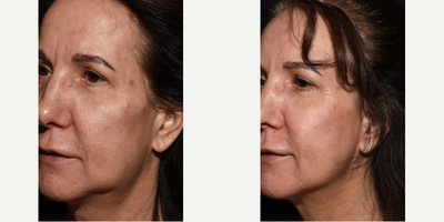 Nonsurgical Facelift before and after photo