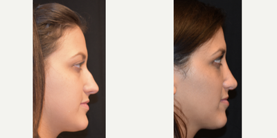Rhinoplasty before and after photo