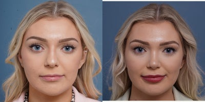Buccal Fat Removal before and after photo