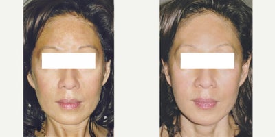 PicoSure before and after photo