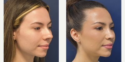 Rhinoplasty before and after photo