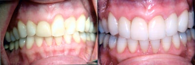 Tooth Repair before and after photo