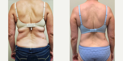 Back Lift before and after photo