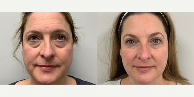 Restylane before and after photo