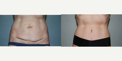 Tummy Tuck before and after photo