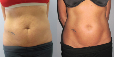 Venus Legacy before and after photo