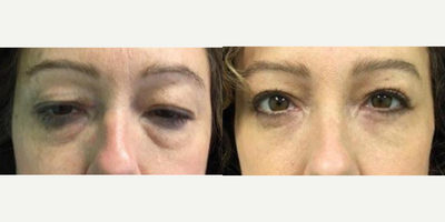Eyelid Surgery before and after photo