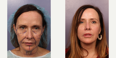 Neck Lift before and after photo