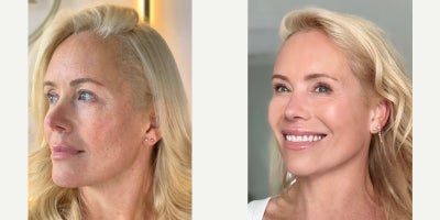 before and after image