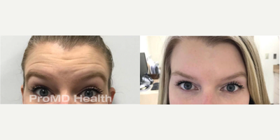 Dysport before and after photo