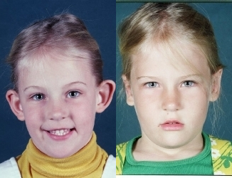 Ear Surgery before and after photo