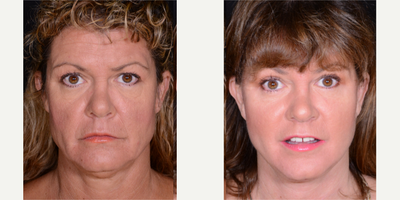 Facelift before and after photo