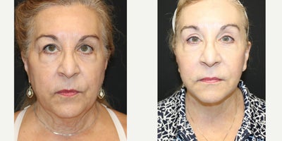Facelift before and after photo