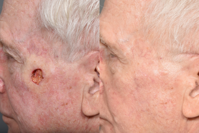 Mohs Surgery before and after photo